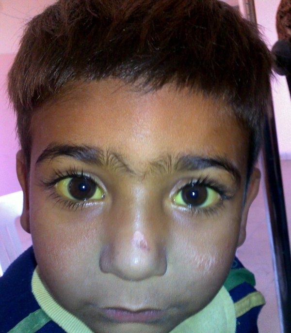 Acute hepatitis WikEM