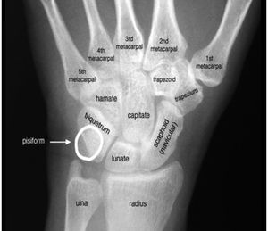 Carpal fractures - WikEM