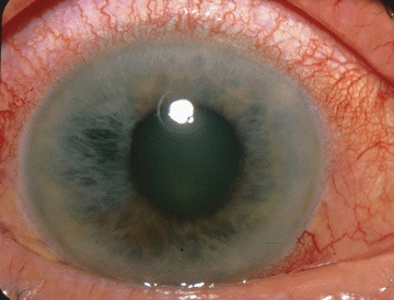 Ciliary/circumcorneal flush and hazy cornea characteristic of acute angle closure glaucoma.