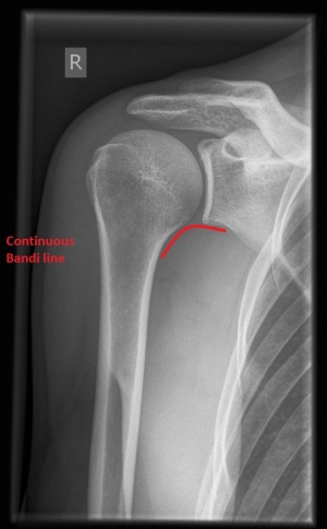 Shoulder x-ray interpretation - WikEM