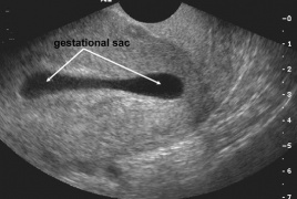 Ultrasound empty sac tilted uterus EMPTY GESTATIONAL