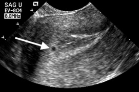 Weeks tilted uterus ultrasound 6 Tilted Uterus: